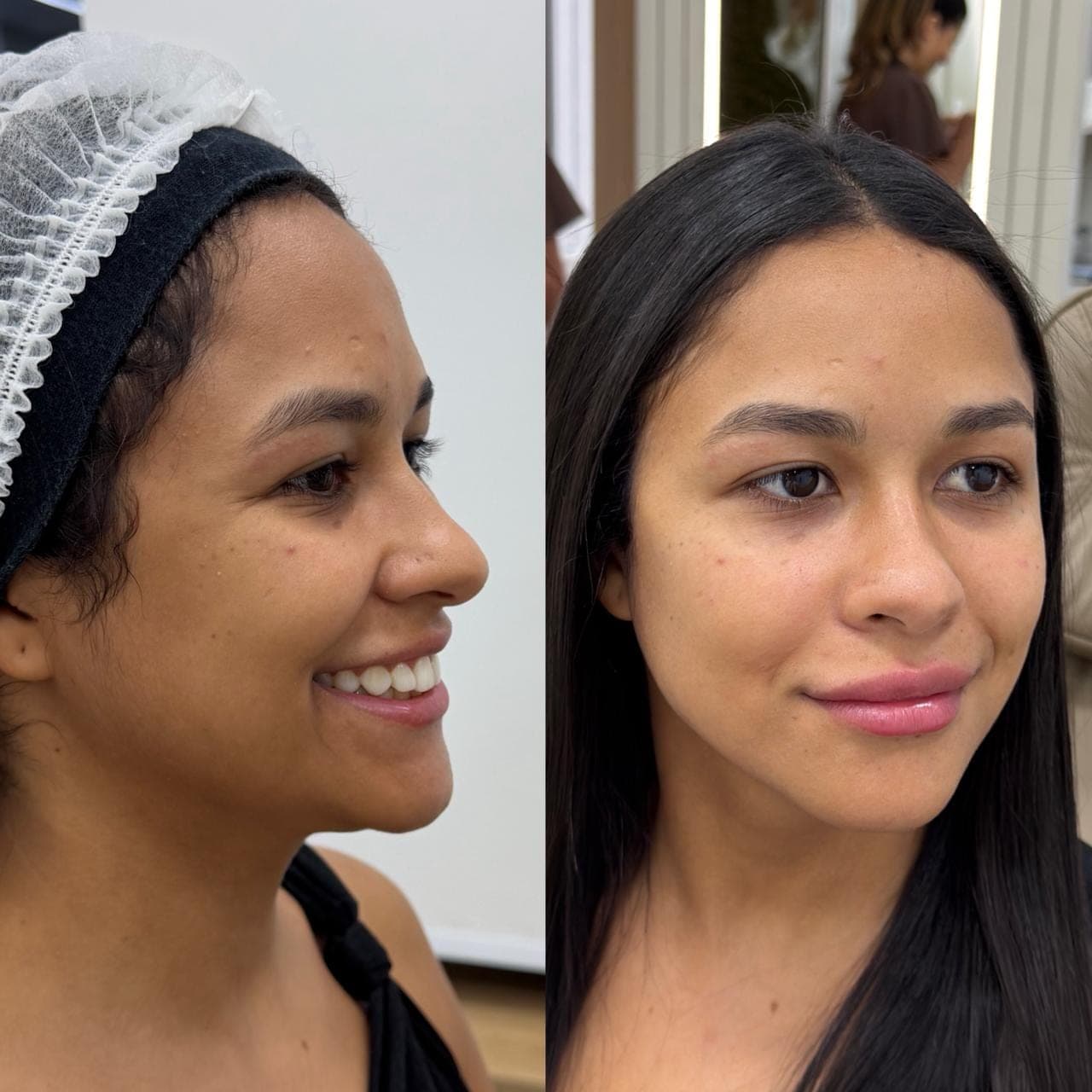 Resultado real de harmonização facial, antes e depois