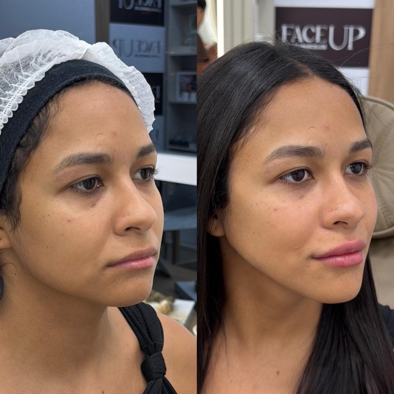 Resultado real de harmonização facial, antes e depois