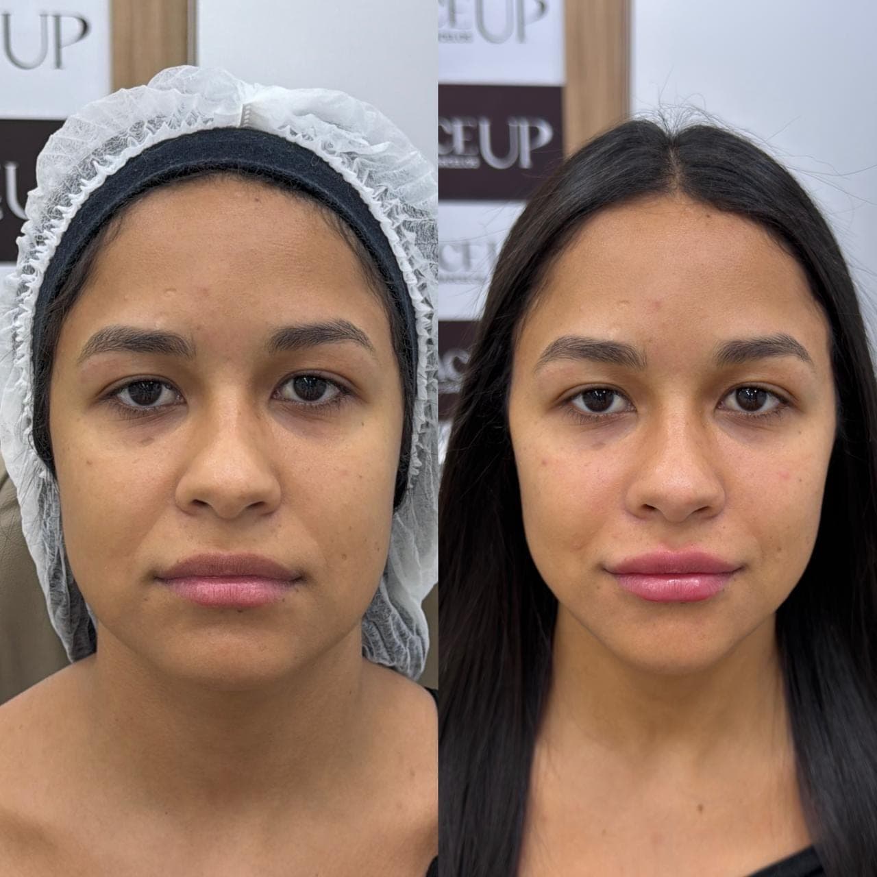 Resultado real de harmonização facial, antes e depois