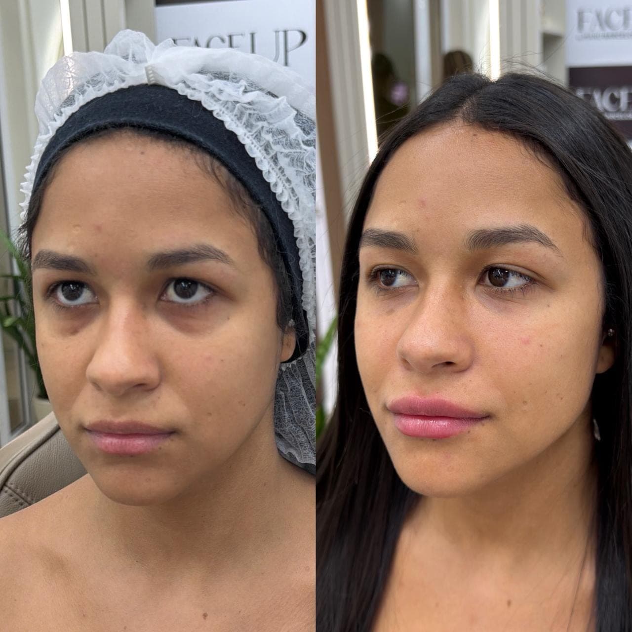Resultado real de harmonização facial, antes e depois