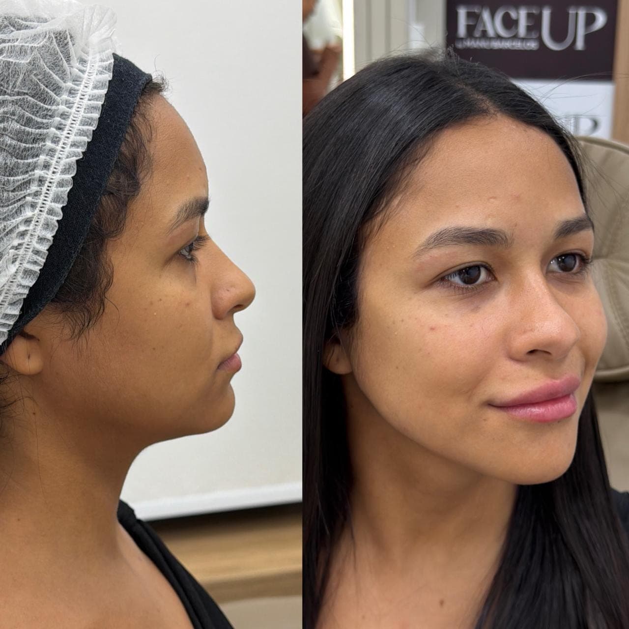 Resultado real de harmonização facial, antes e depois