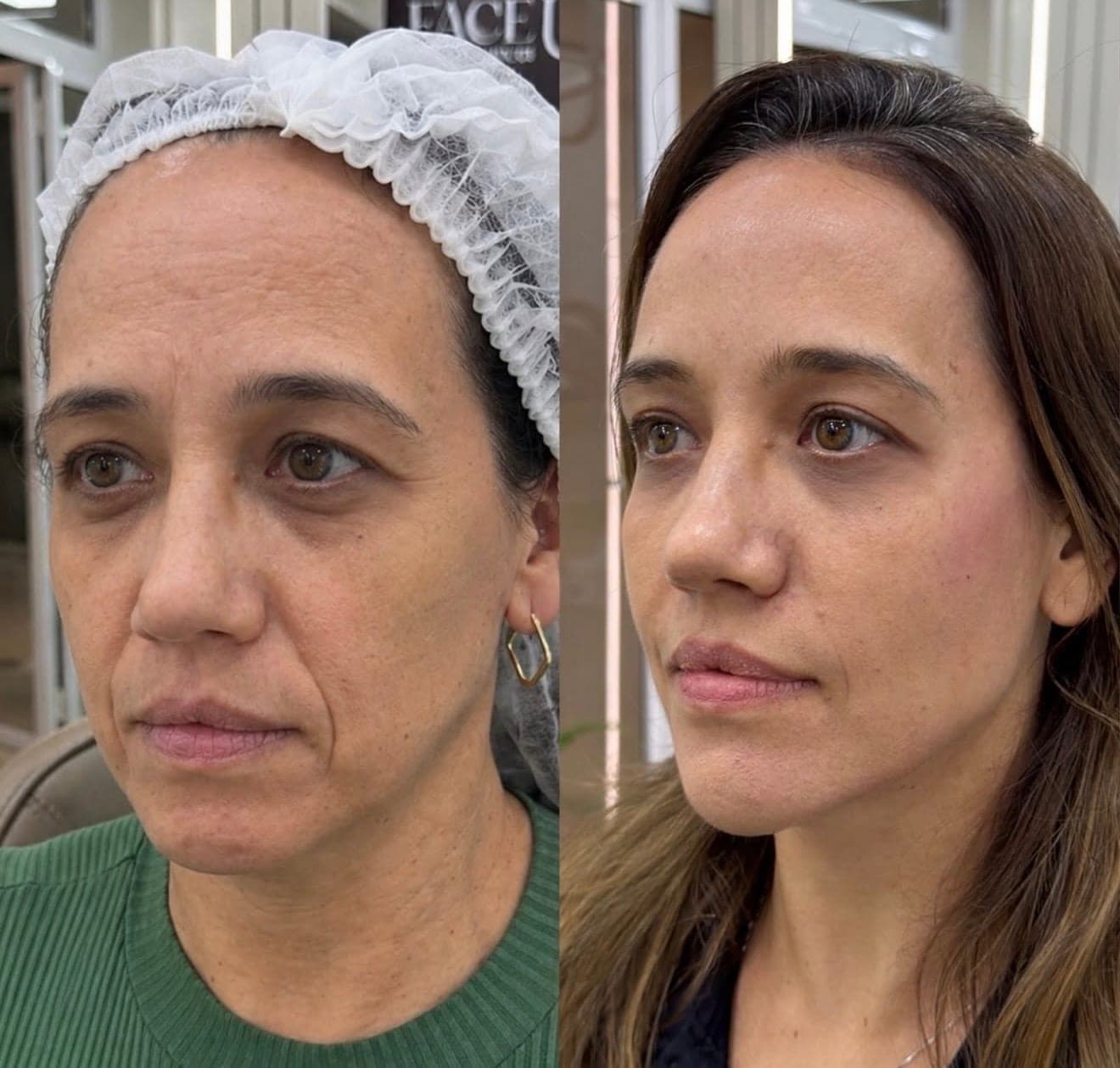 Resultado real de harmonização facial, antes e depois