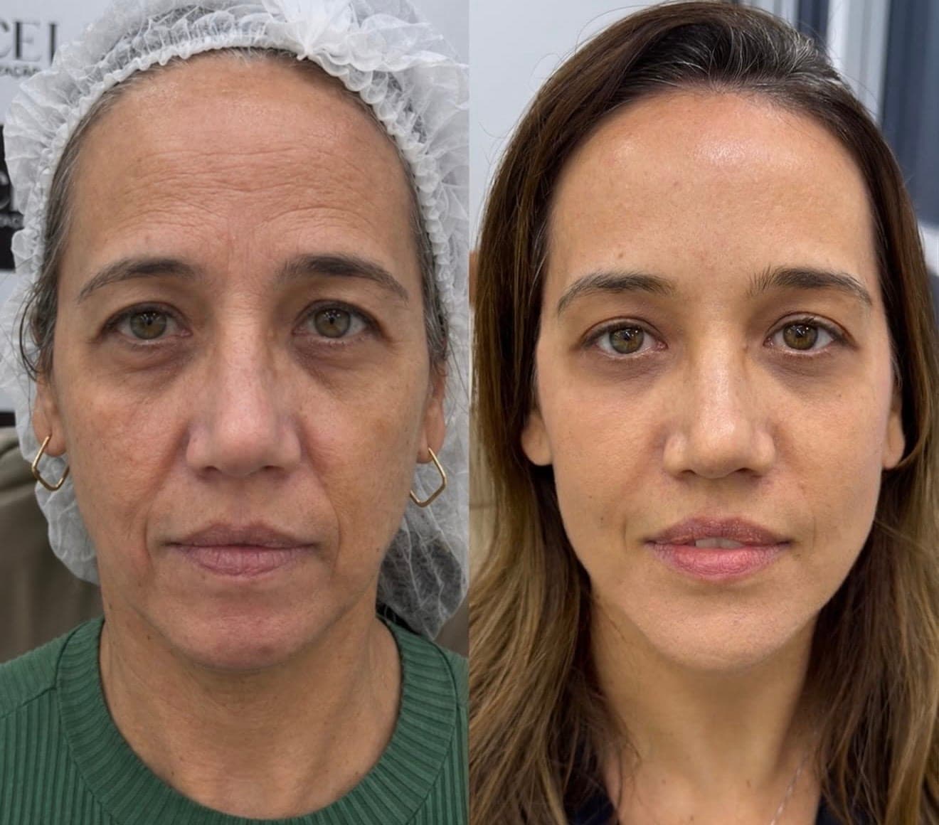 Resultado real de harmonização facial, antes e depois
