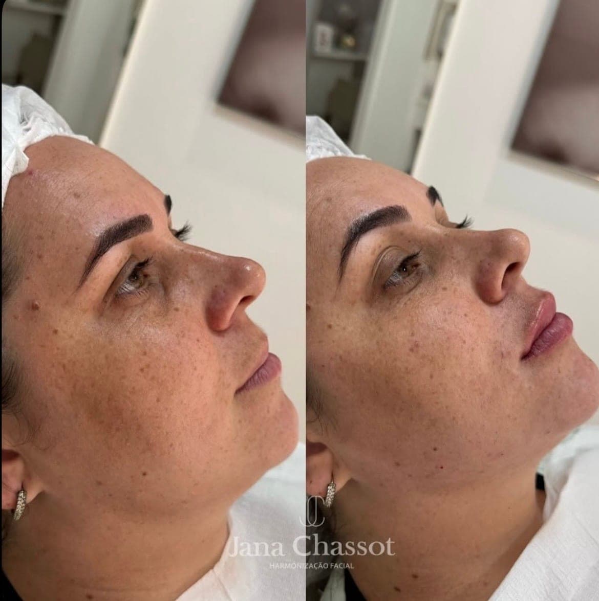 Resultado real de harmonização facial, antes e depois