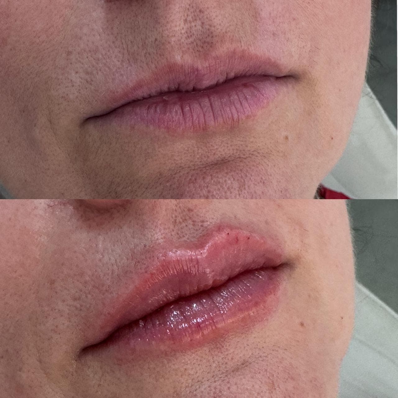 Resultado real de preenchimento labial, antes e depois
